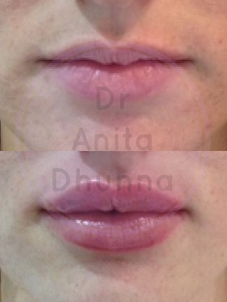 Before and After Lip Enhancement by Dr Anita Dhunna