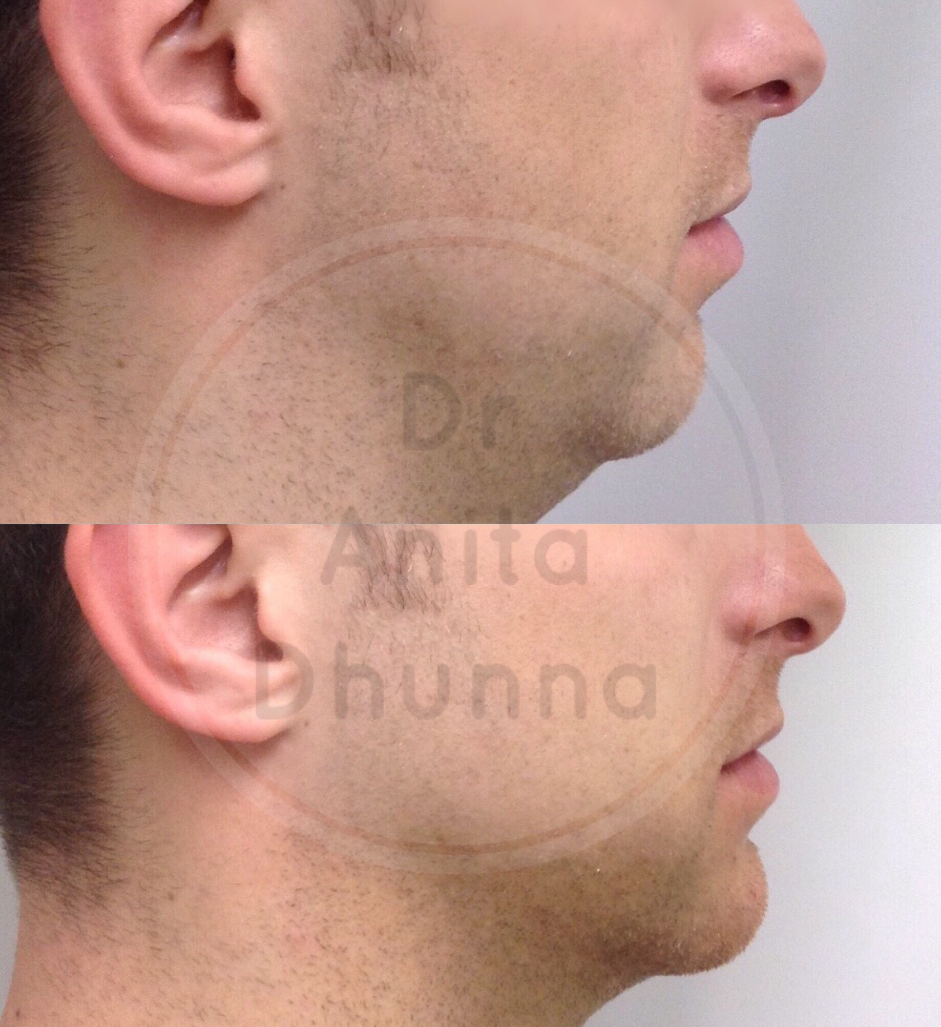 Before and After Jawline/Chin Contouring by Dr Anita Dhunna