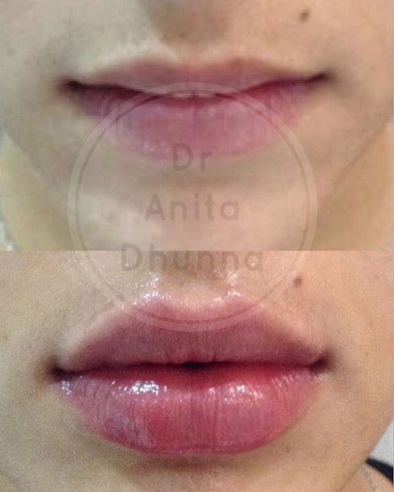 Before and After Lip Enhancement by Dr Anita Dhunna