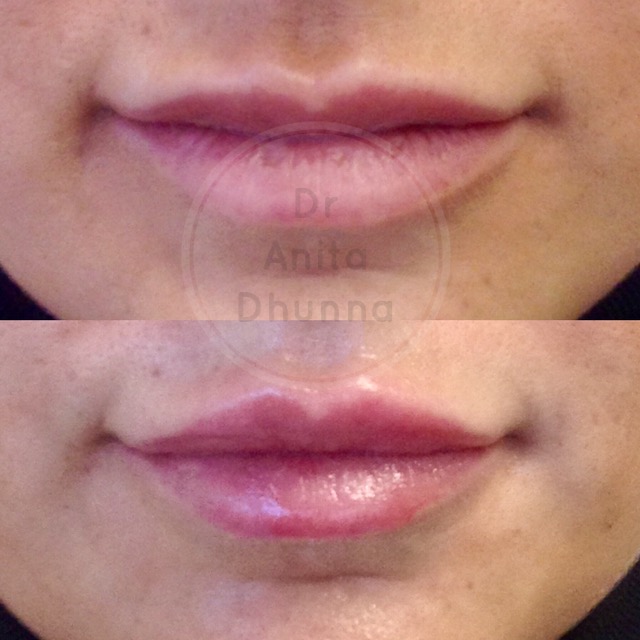 Before and After Lip filler Essexby Dr Anita Dhunna