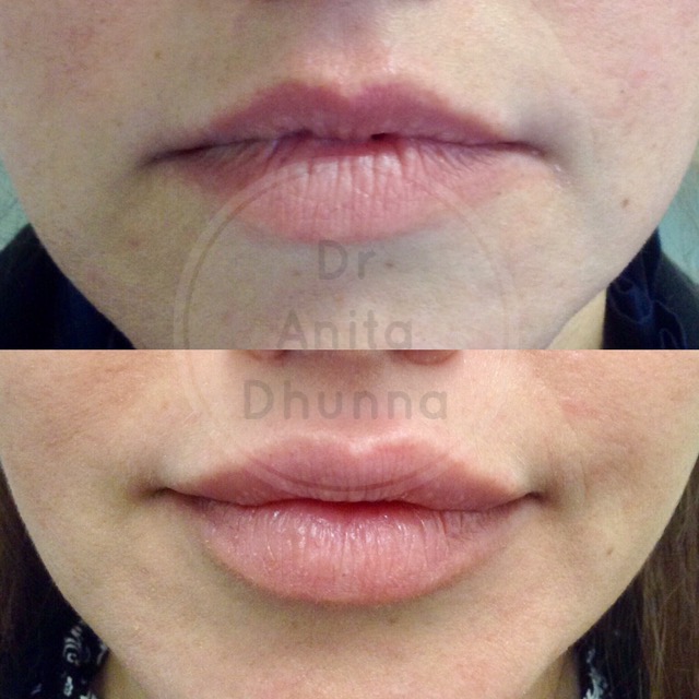 Before and After Lip Enhancement by Dr Anita Dhunna
