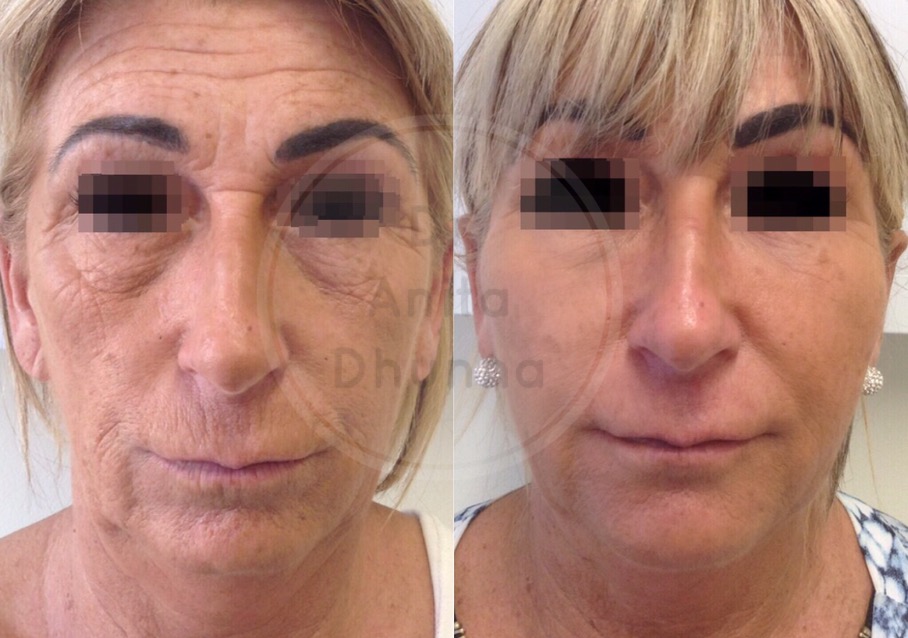 Before and After Non Surgical Facelifting by Dr Anita Dhunna