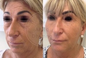 surgical dhunna anita facelift