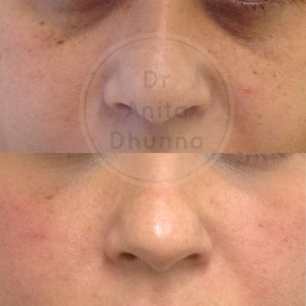 Before and after Tear Trough Treatment by Dr Anita Dhunna
