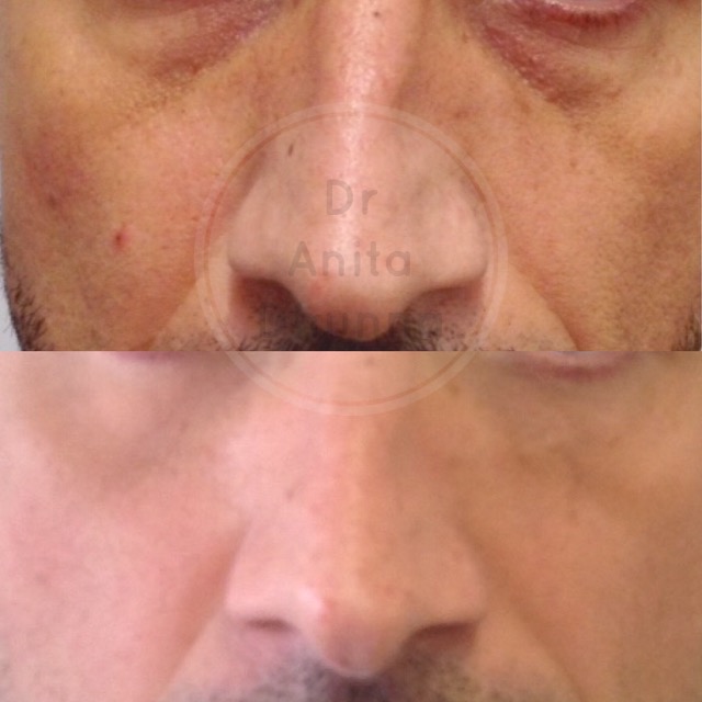 Before and after Tear Trough Treatment by Dr Anita Dhunna
